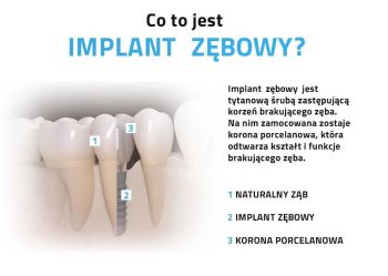 Co to jest implant zębowy