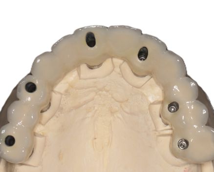 mosty-na-implantach-024