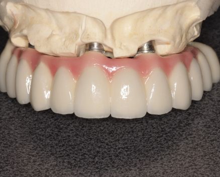 mosty-na-implantach-026