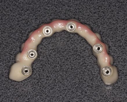 mosty-na-implantach-030