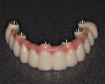 mosty-na-implantach-032