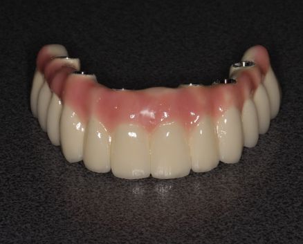 mosty-na-implantach-094